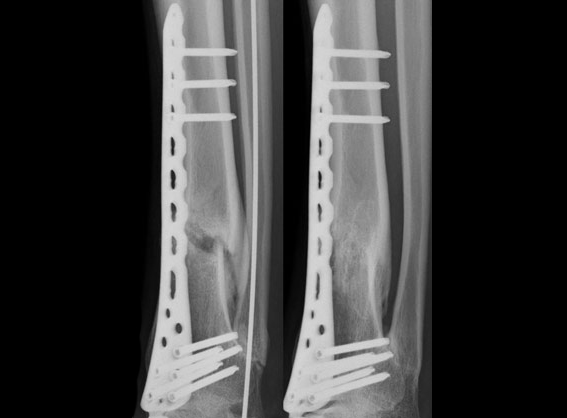 Radiographs of stubborn fractures before (left) and after (right) treatment with stem cells.