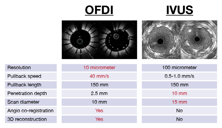 OFDI (left) provides higher resolution images of the insides of heart vessels compared to UVIS (right).