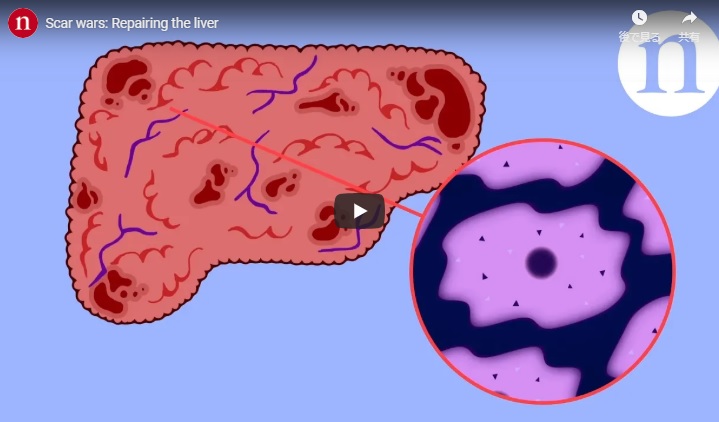 Long considered to be permanent, the extensive scarring found in livers with cirrhosis is now thought to be reversible. As understanding of scar formation grows, scientists are inching closer to treatments that will help to stop scarring and heal existing liver damage.