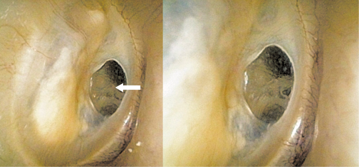 Figure 3. Tympanic membrane that has healed spontaneously. The white arrow points to a transparent area of tympanic membrane that has formed without the middle layer. No nutrient vessels can be seen. The edge of the middle layer can be observed as a white margin surrounding the transparent tympanic membrane.