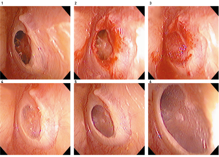Figure 7. Tympanic membrane regeneration in a 65-year-old woman who had chronic otitis media for 30 years. 1, Before regeneration treatment; 2, transformation of the tympanic membrane perforation edge into an open wound; 3, placement of bFGF impregnated gelatin sponge and covering with fibrin glue; 4, regenerated tympanic membrane and remaining gelatin sponge in the tympanic cavity 3 weeks after treatment; 5,6, the gelatin sponge in the tympanic cavity is eliminated, and numerous capillaries are observed in the regenerated tympanic membrane 4 months after treatment.