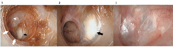 Figure 9. Tympanic membrane regeneration in a 39-year-old woman with chronic otitis media. Fibrescope images (1, 2) before treatment and (3) two months after treatment. The patient had otorrhea and calcification in the remaining tympanic membrane (black arrows). The perforation edge could not be directly observed microscopically because of the extension of the anterior and lower walls of the external auditory canal (white arrows). Regeneration treatment was performed after washing the inside of the tympanic cavity and removing the calcified remaining tympanic membrane endoscopically. The regenerated tympanic membrane is virtually normal without calcification 2 months after treatment.