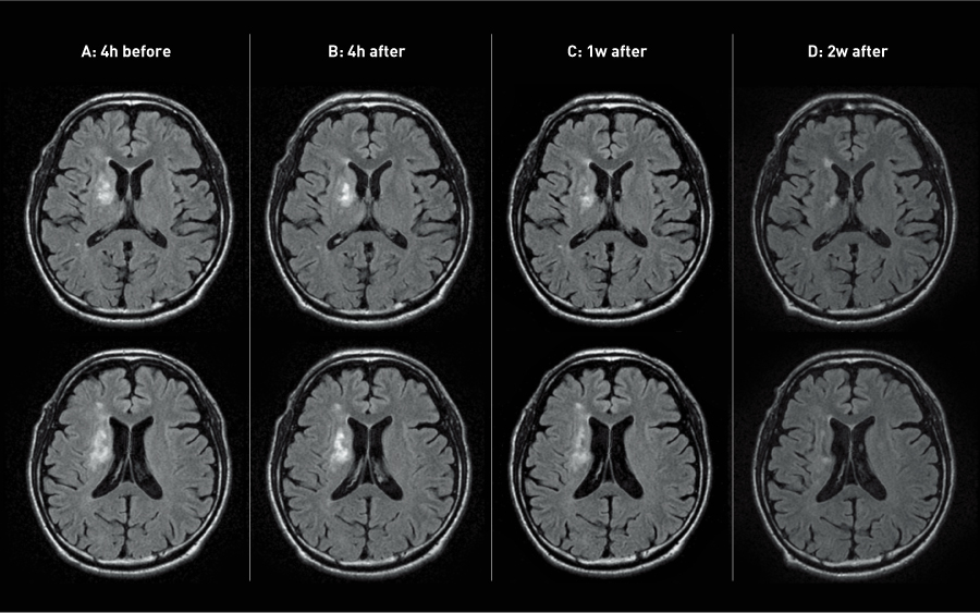Figure 2. Magnetic resonance imaging images of patients’ brains before and after the administration of mesenchymal stem cells.