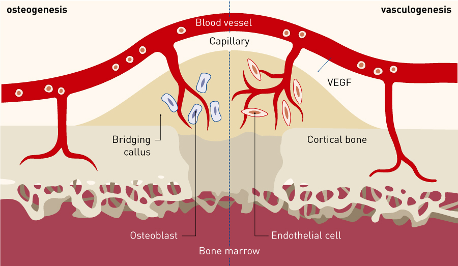 Figure 1. Kinetics of peripheral blood CD34+ cells in fracture healing. Intravenously transplanted human peripheral blood CD34+ cells were found to accumulate at the nonunion site, induce an environment suitable for fracture healing at the non-union site through both vasculogenesis and osteogenesis, and contribute to fracture healing.