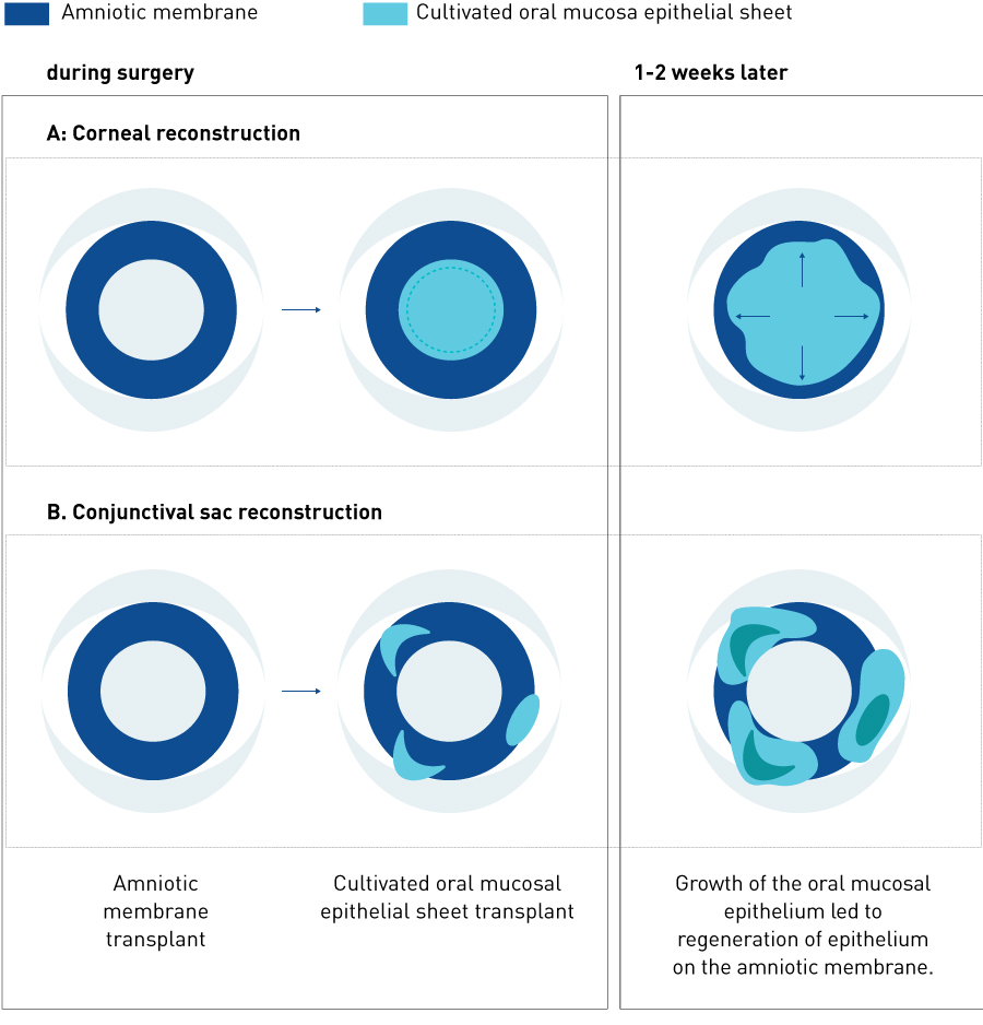 Figure 3. Extension of epithelial cells from the cultivated mucosal epithelial sheet after transplantation. A, Corneal reconstruction; B, conjunctival sac reconstruction.