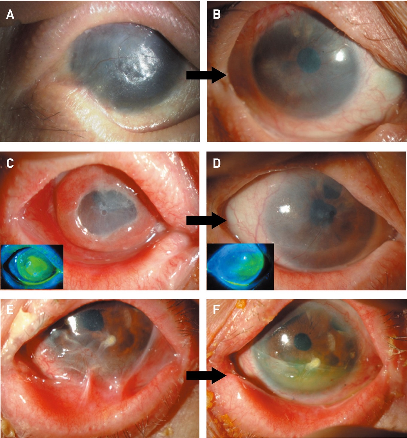 Figure 5. Representative cases. A, B, Epithelial sheet transplantation was performed 0.9 for visual improvement; C, D, for epithelial repair; E, F, for fornix reconstruction. Photographs were taken before surgery (A, C, E) and at the 24th postoperative week (B, D, F). (Modified from Refs. 32 and 34.)