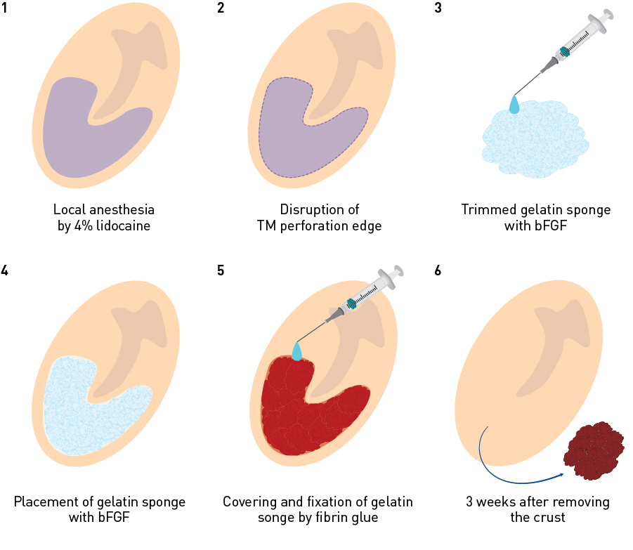Figure 6. Steps involved in tympanic membrane regeneration therapy. 1. Infiltration anesthesia of the remaining tympanic membrane and the tympanic membrane perforation edge with a 4% lidocaine swab; 2. Transformation of the tympanic membrane edge into an open wound; 3, 4. Placement of bFGF-impregnated gelatin sponge; 5. Covering the bFGF-impregnated gelatin sponge with fibrin glue; 6. Removal of the crust three weeks after treatment.