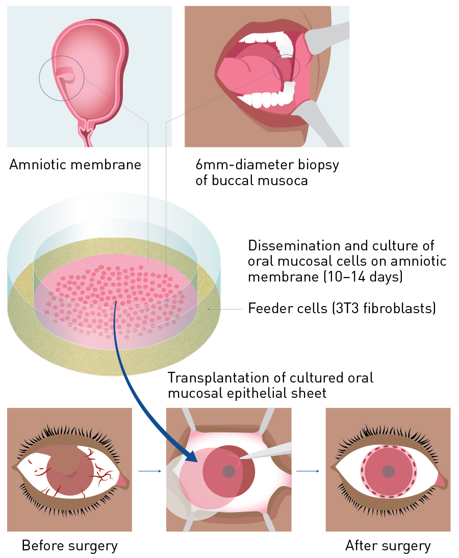 Figure 2. Procedure for transplanting cultivated autologous oral mucosal epithelial sheets. A mucosal specimen containing the oral mucosal epithelium was collected to create an oral mucosal epithelial sheet at the Cell Procession Center. After about 2 weeks, this stratified epithelial sheet was used for cultivated oral mucosal epithelial sheet transplantation.