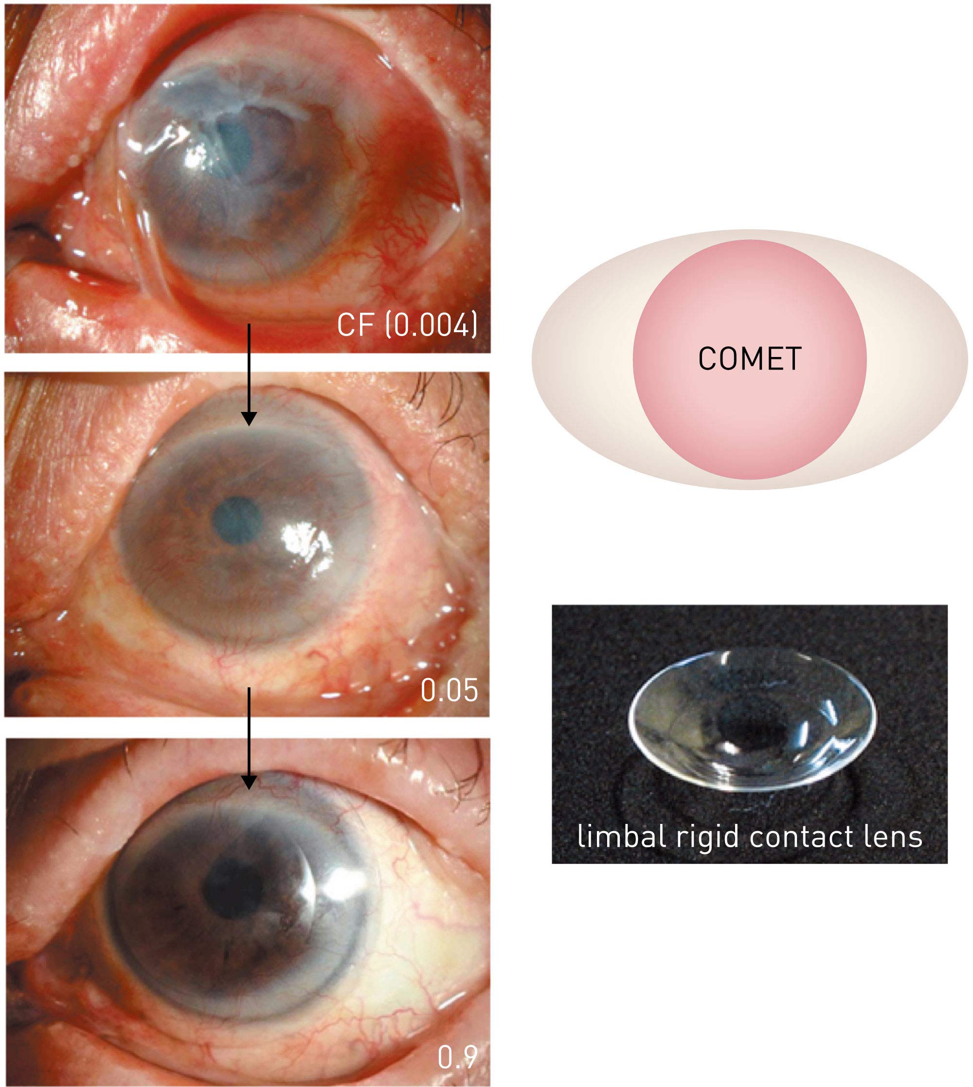 Figure 6. Improvement in visual function using limbal rigid contact lenses. A patient with Stevens–Johnson syndrome with severe adhesion on the ocular surface and a preoperative vision of counting fingers (0.004). The patient’s own oral mucosal epithelium transplanted onto the cornea was nearly stabilized 6 months after surgery,improving visual acuity to 0.05; the use of limbal rigid contact lenses further improved visual acuity to 0.9–1.0. This improvement has been maintained for over 7 years since surgery. (Modified from Ref. 43.) COMET, cultivated oral mucosal epithelial sheet transplantation