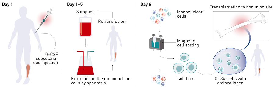 Figure 2. Overview of the clinical study. CD34+ cells were mobilized into the peripheral blood by subcutaneous injection of G-CSF, mononuclear cells were collected by apheresis,and then CD34+ cells were isolated by magnetic-activated cell sorting. Non-union surgery (improvement of internal fixation as necessary in addition to autologous bone grafting) was performed on day 6 and 5 ×105 cells kg–1 of autologous peripheral blood CD34+ cells were transplanted using atelocollagen as a carrier. G-CSF, granulocyte colony stimulating factor.